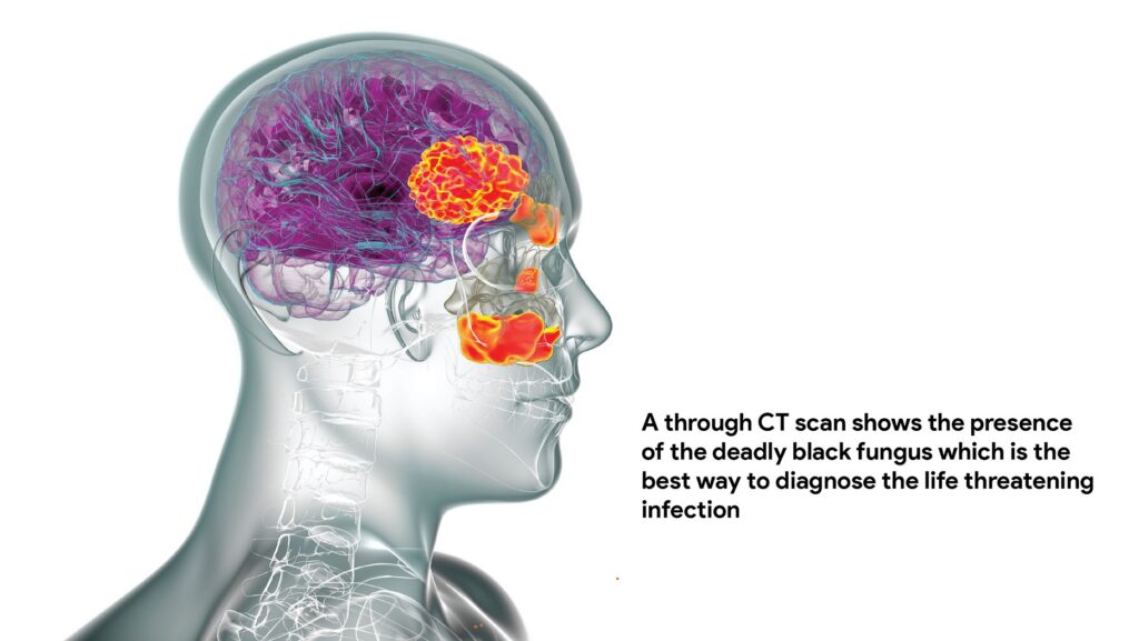 A through CT scan