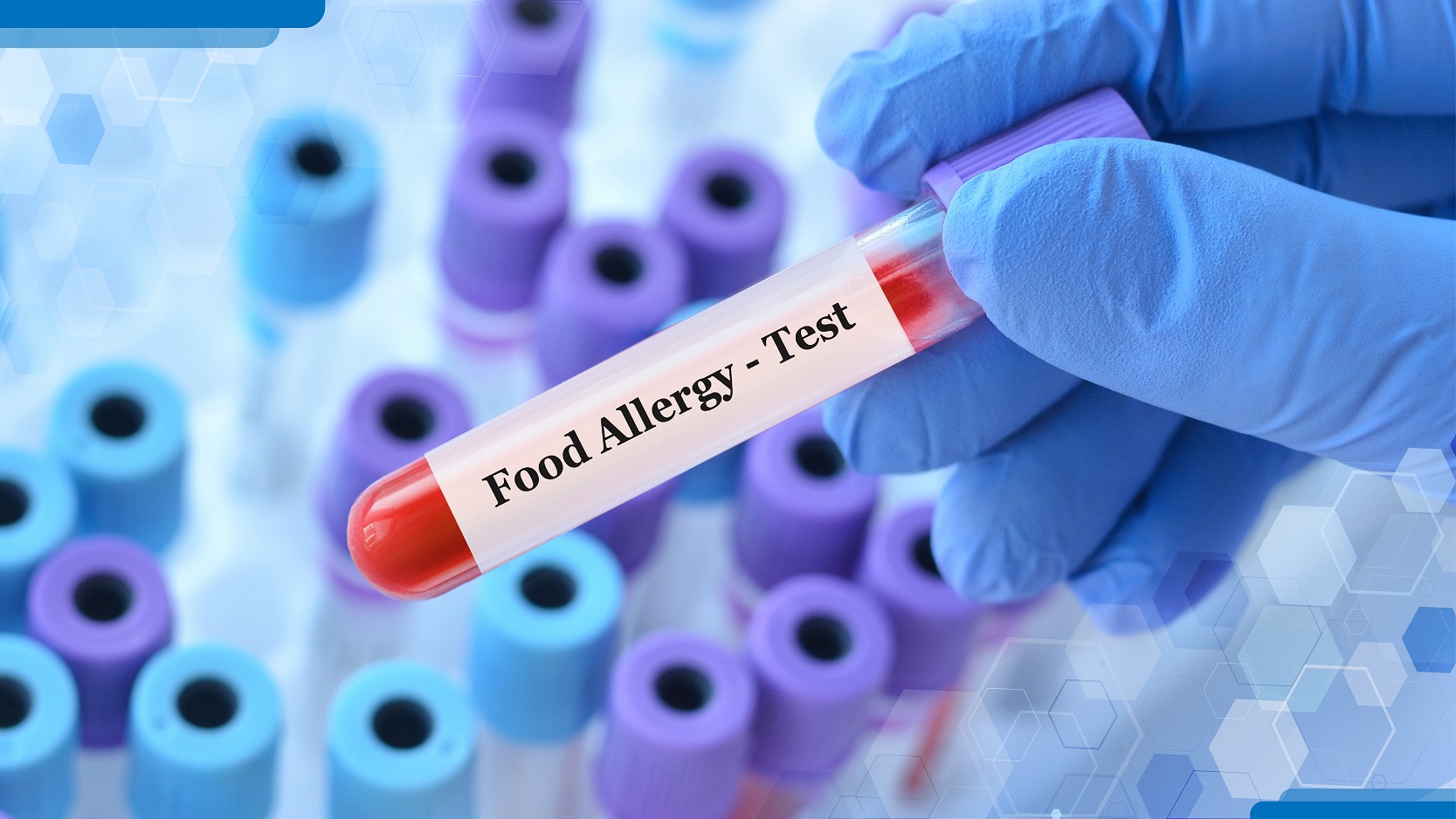 Understanding the importance of food allergy testing